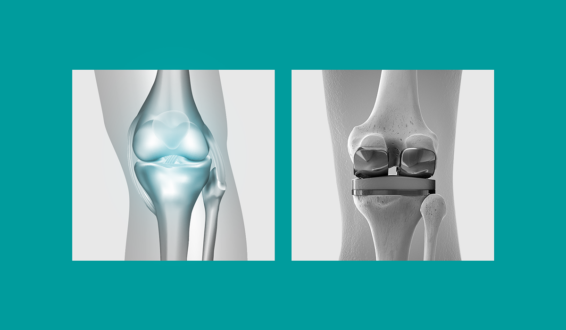 Биоимплант суставов: революция в области восстановительной медицины и ортопедии