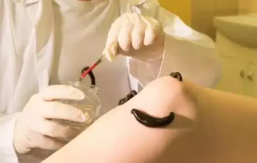 Преимущества лечения медицинскими пиявками