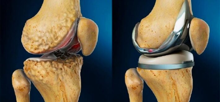 Эндопротезирование коленного сустава