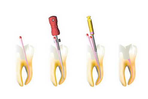 Види інструментів для пломбування зубних каналів