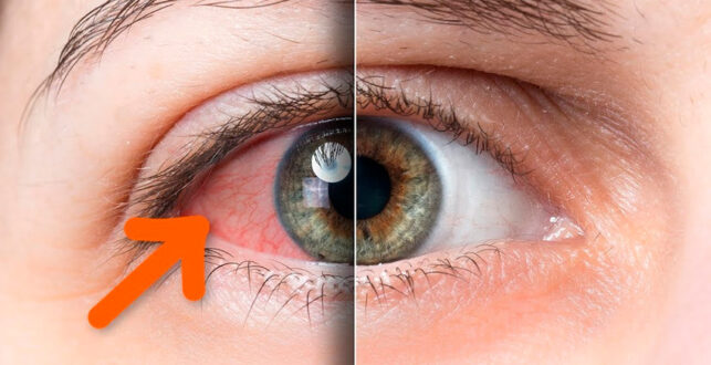 Причины развития синдрома сухого глаза