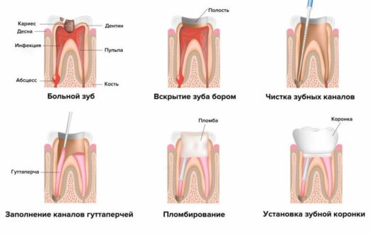 Лечение хронического периодонтита