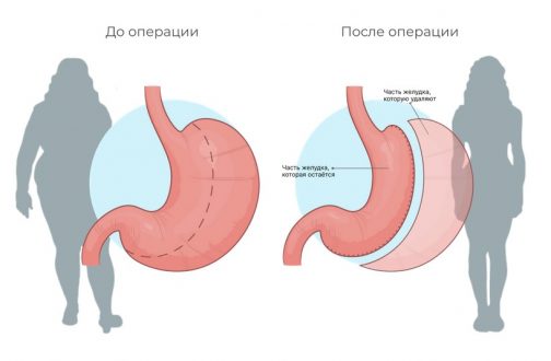 От чего зависит цена на бариатрическую операцию