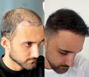 Эффективные методы пересадки волос: Как выбрать лучшее решение для вашей проблемы