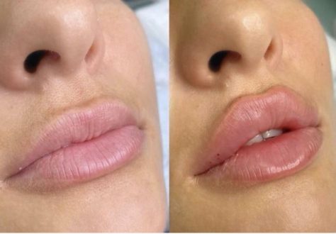 Как выбрать лучший филлер: рейтинг лучших филлеров для губ и лица