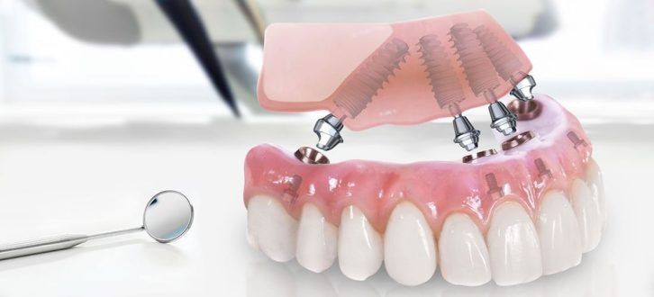 Протезирование зубов: восстановление улыбки и функции жевания