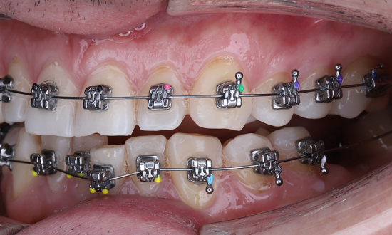Ортодонтическое лечение: путь к красивой улыбке и здоровым зубам
