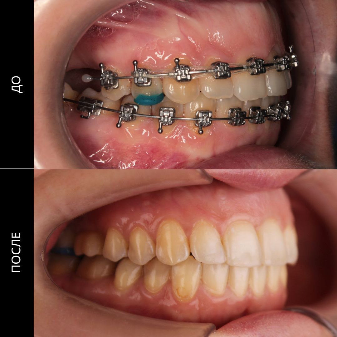 Исправление прикуса: современные методы, этапы и советы ортодонтов
