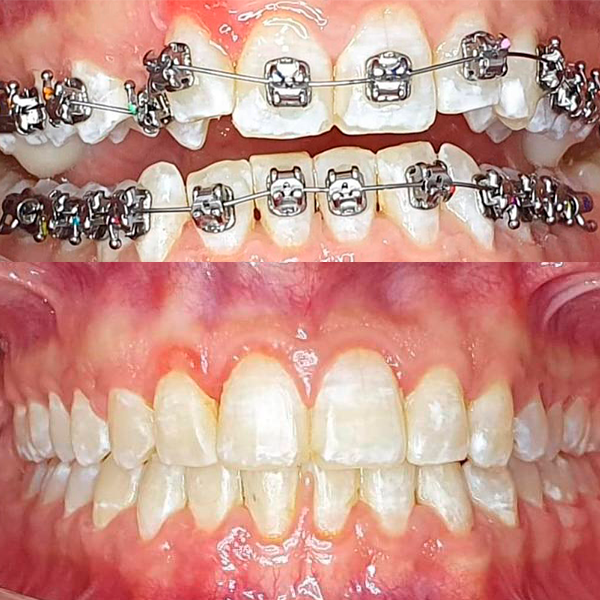Исправление прикуса: современные методы, этапы и советы ортодонтов