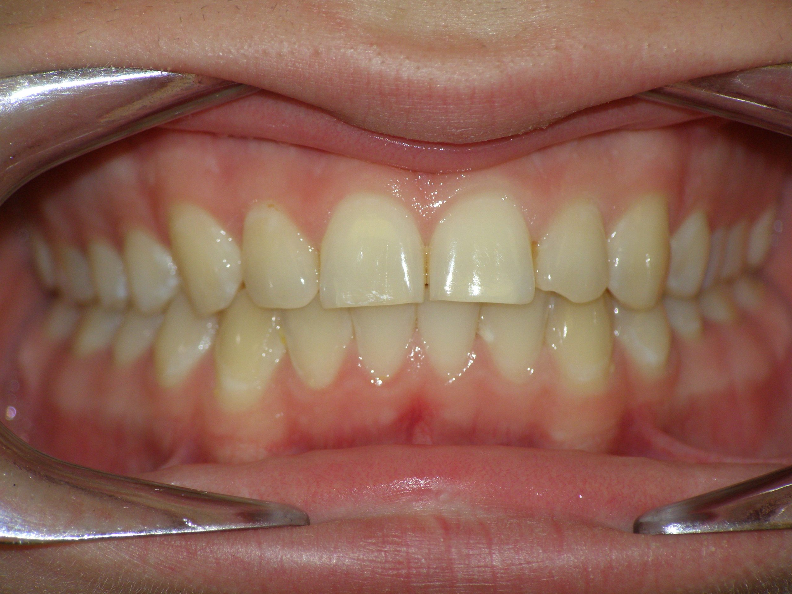 Исправление прикуса: современные методы, этапы и советы ортодонтов