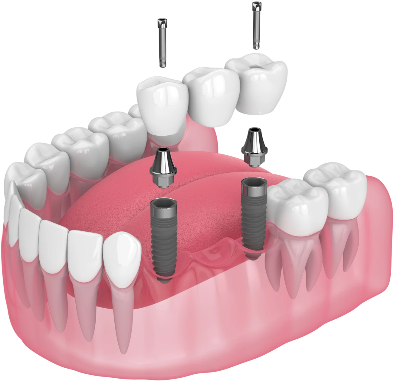 Мостовидное протезирование зубов: виды, материалы и этапы установки