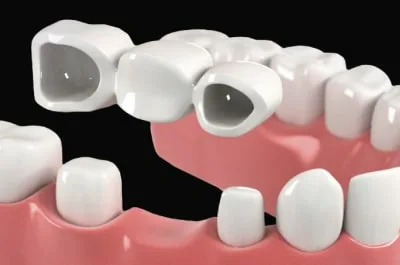 Мостовидное протезирование зубов: виды, материалы и этапы установки